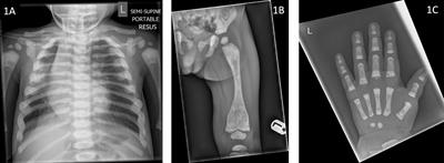 Case Report: Osteosclerotic metaphyseal dysplasia with optic nerve involvement and progressive osteonecrosis of the jaw due to a novel LRRK1 mutation